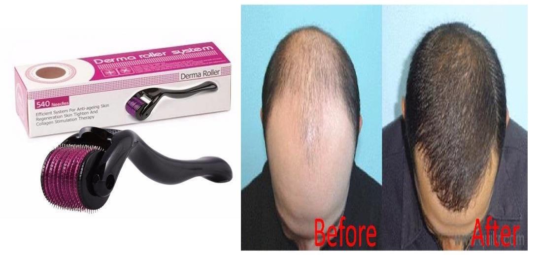 Pack of 2 Derma Roller - 0.5MM For Wrinkles, Acne Scar Removal,